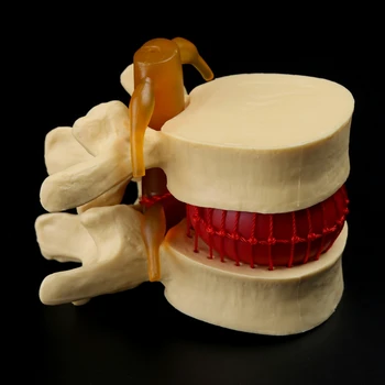 Dropship Žmogaus Anatomija Skeletas Stuburo Juosmens Disko Herniation Mokymo Modelį Rekvizitai