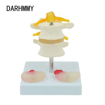 DARHMMY Žmogaus Juosmens Modelis Su 2 Sergančių Tarpslanksteliniai Diskai Stuburo Nervų Šaknis ir Skeleto Anatomijos, Medicinos Mokymo Ekranas